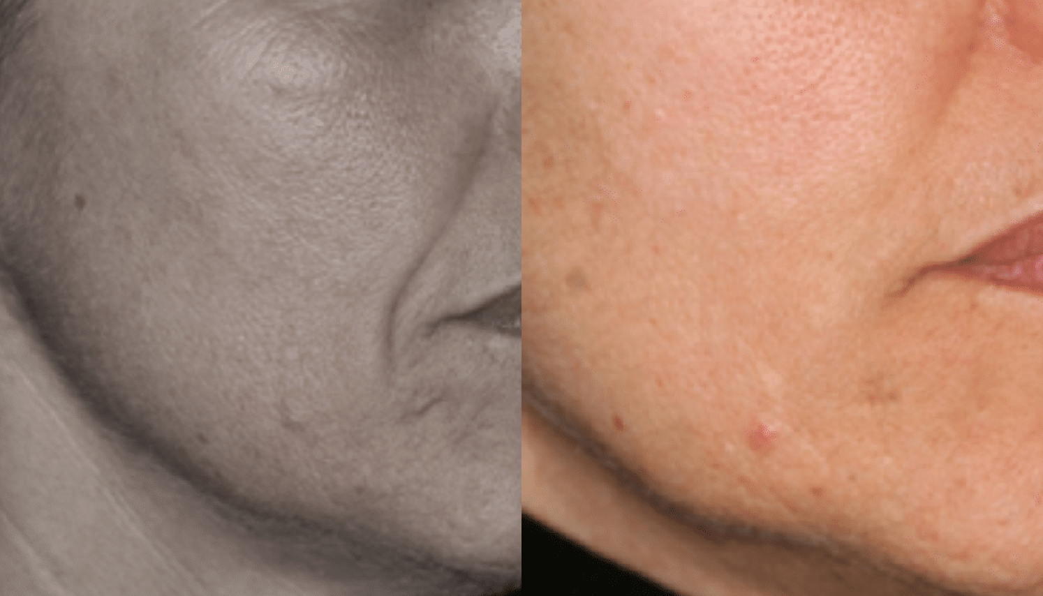 Microagulhamento | Derma Pen & Roller 7 Microagulhamentos-3