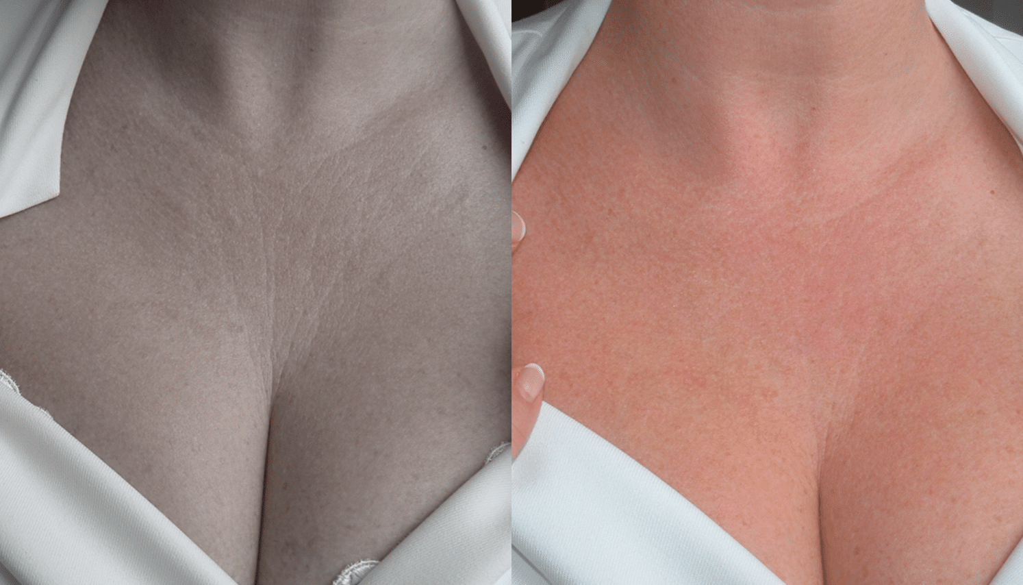 Microagulhamento | Derma Pen & Roller 8 Microagulhamentos-4