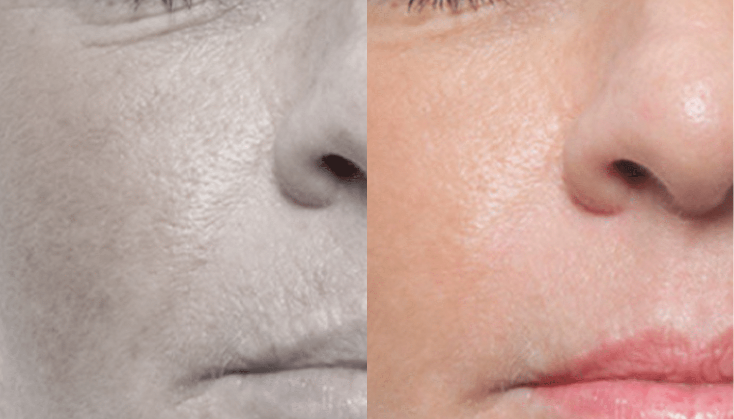 Microagulhamento | Derma Pen & Roller 9 Microagulhamentos-5