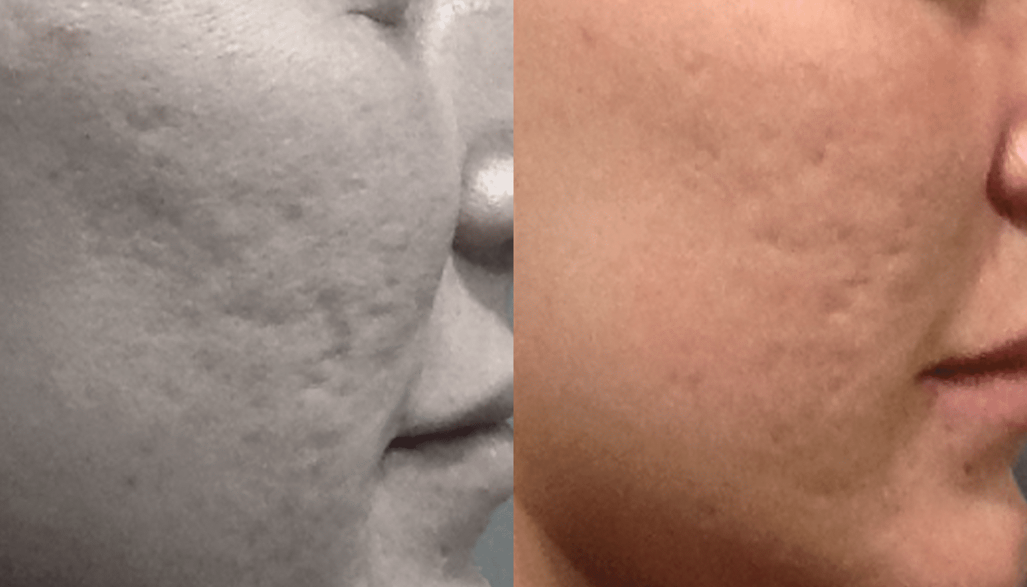 Microagulhamento | Derma Pen & Roller 10 Microagulhamentos-6