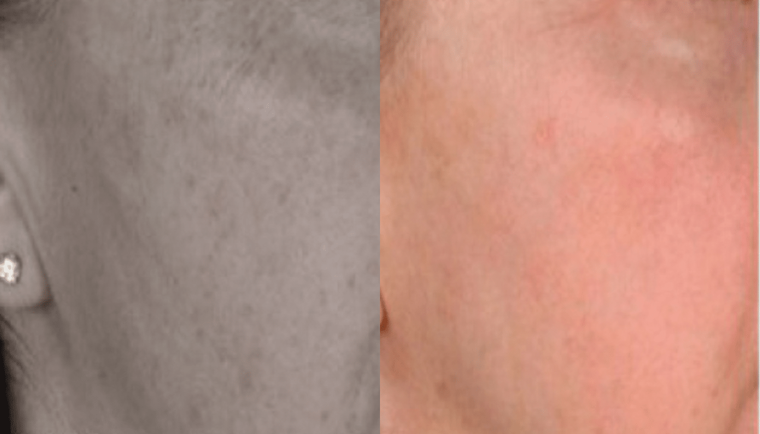 Microagulhamento | Derma Pen & Roller 11 Microagulhamentos-7