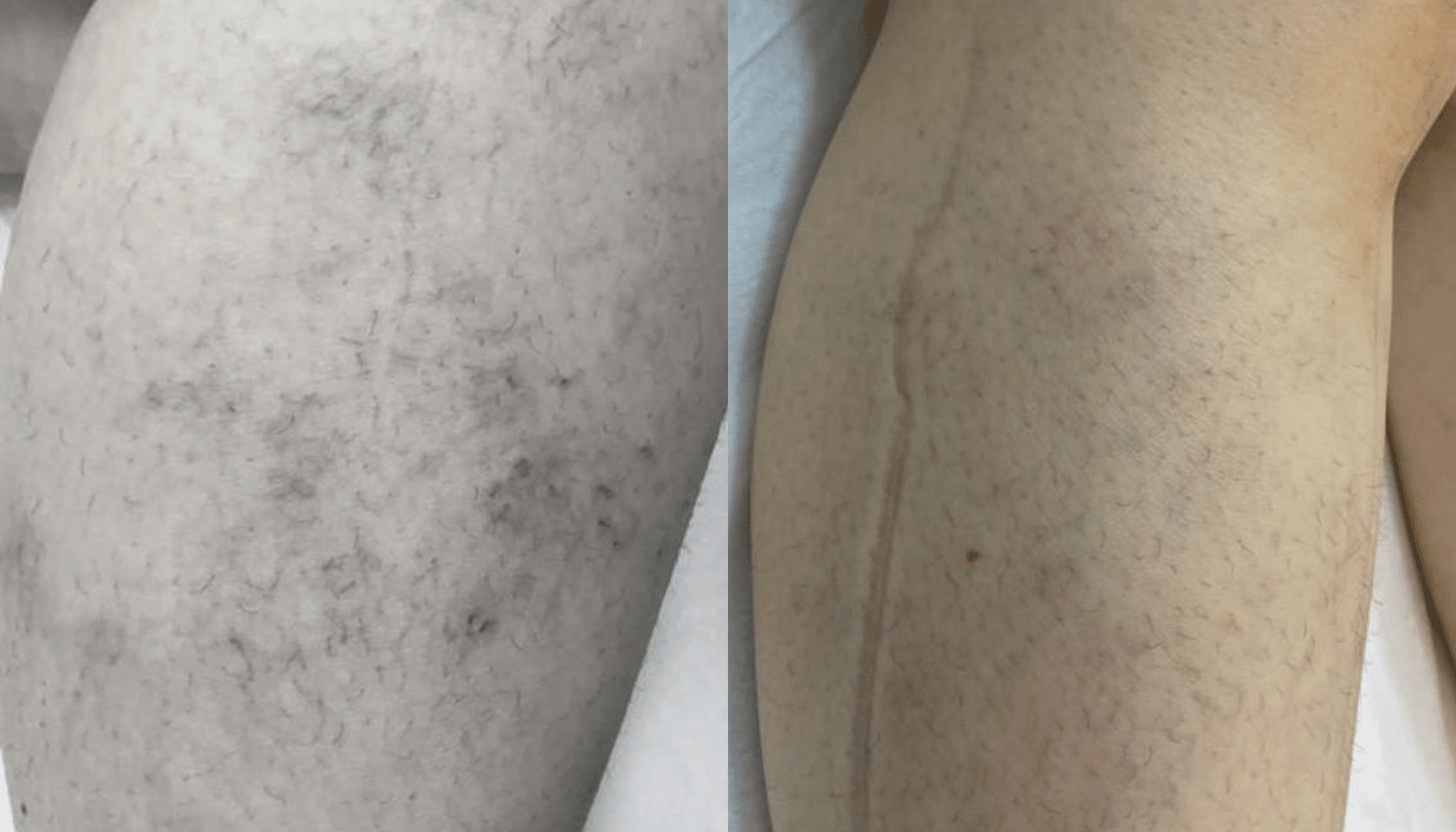 PEIM | Tratamento de Microvasos - Salvador 8 Ozonioterapia-1