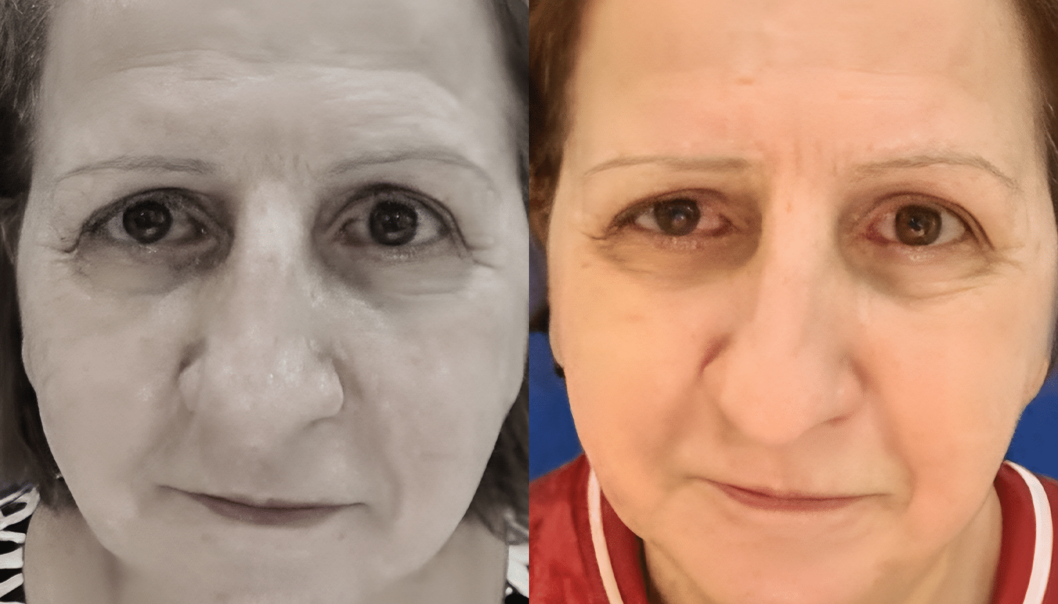 Ozonioterapia Estética Avançada - Florianópolis 8 Ozonioterapia-2