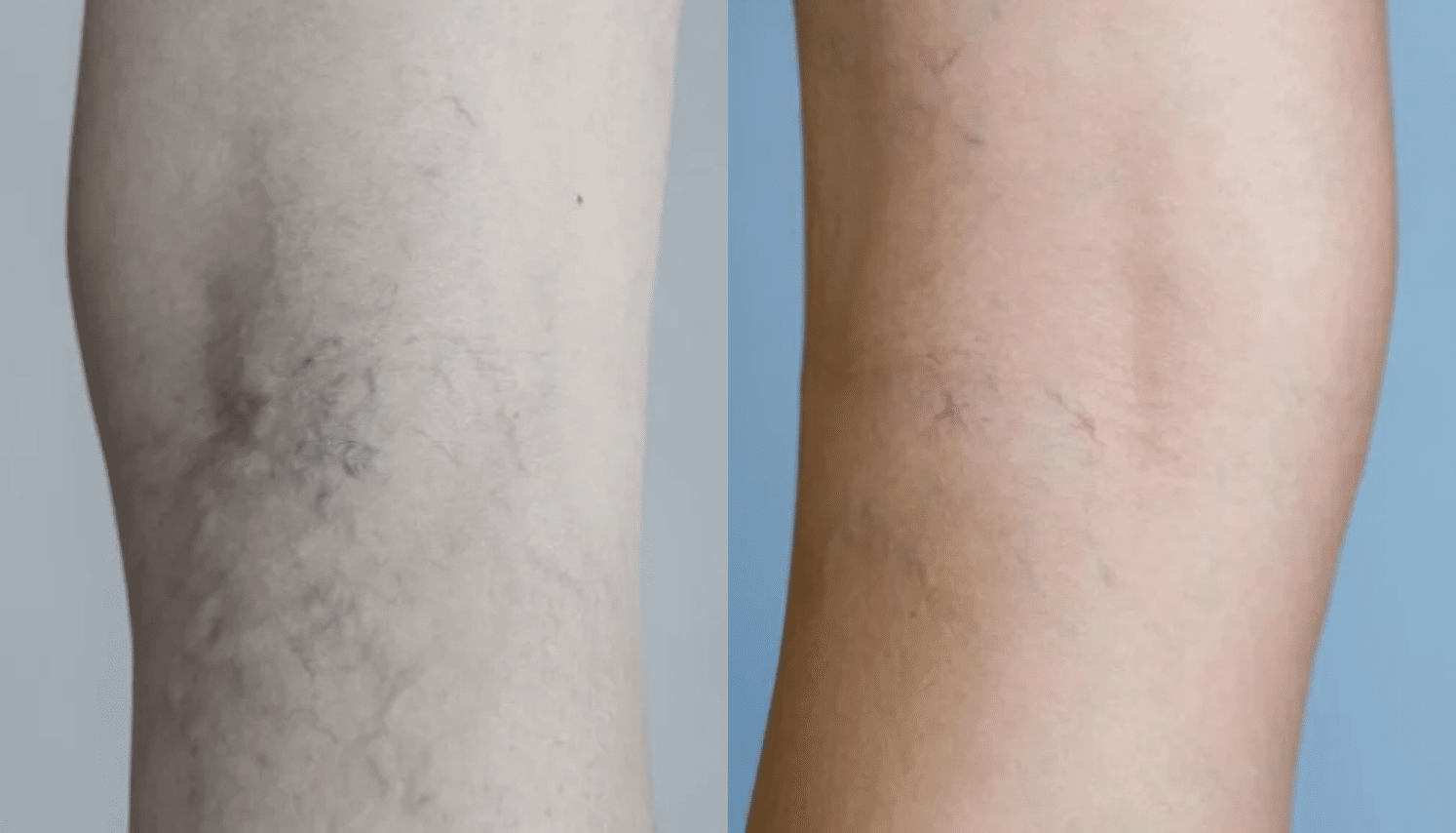 PEIM | Tratamento de Microvasos - Salvador 9 Ozonioterapia-2