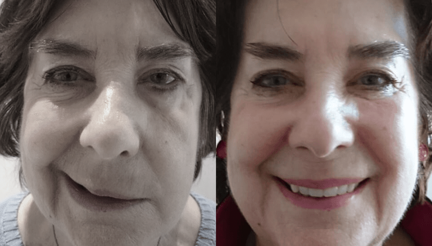 Ozonioterapia Estética Avançada - Florianópolis 9 Ozonioterapia-3