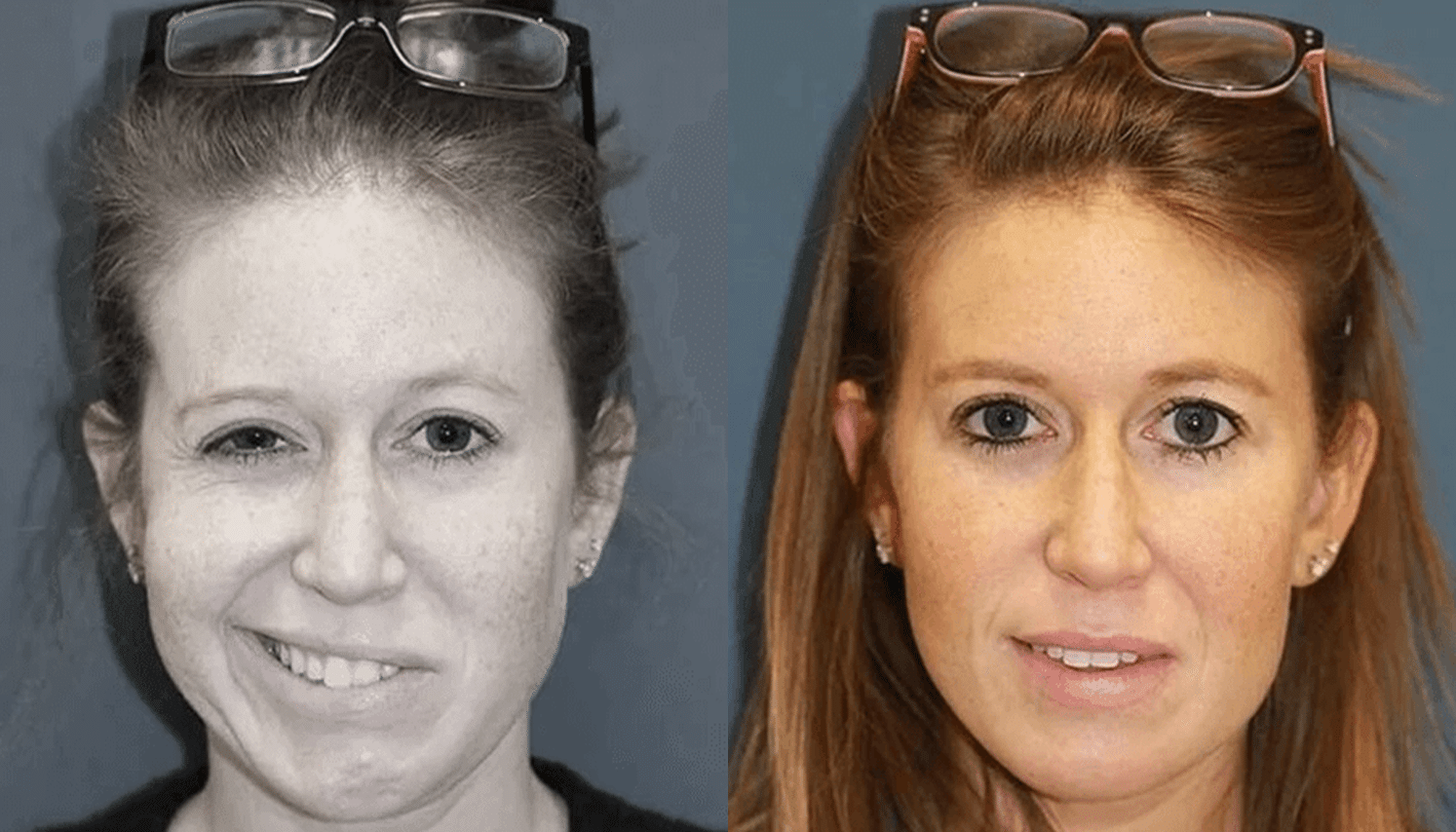 Ozonioterapia Estética Avançada - Florianópolis 10 Ozonioterapia-4