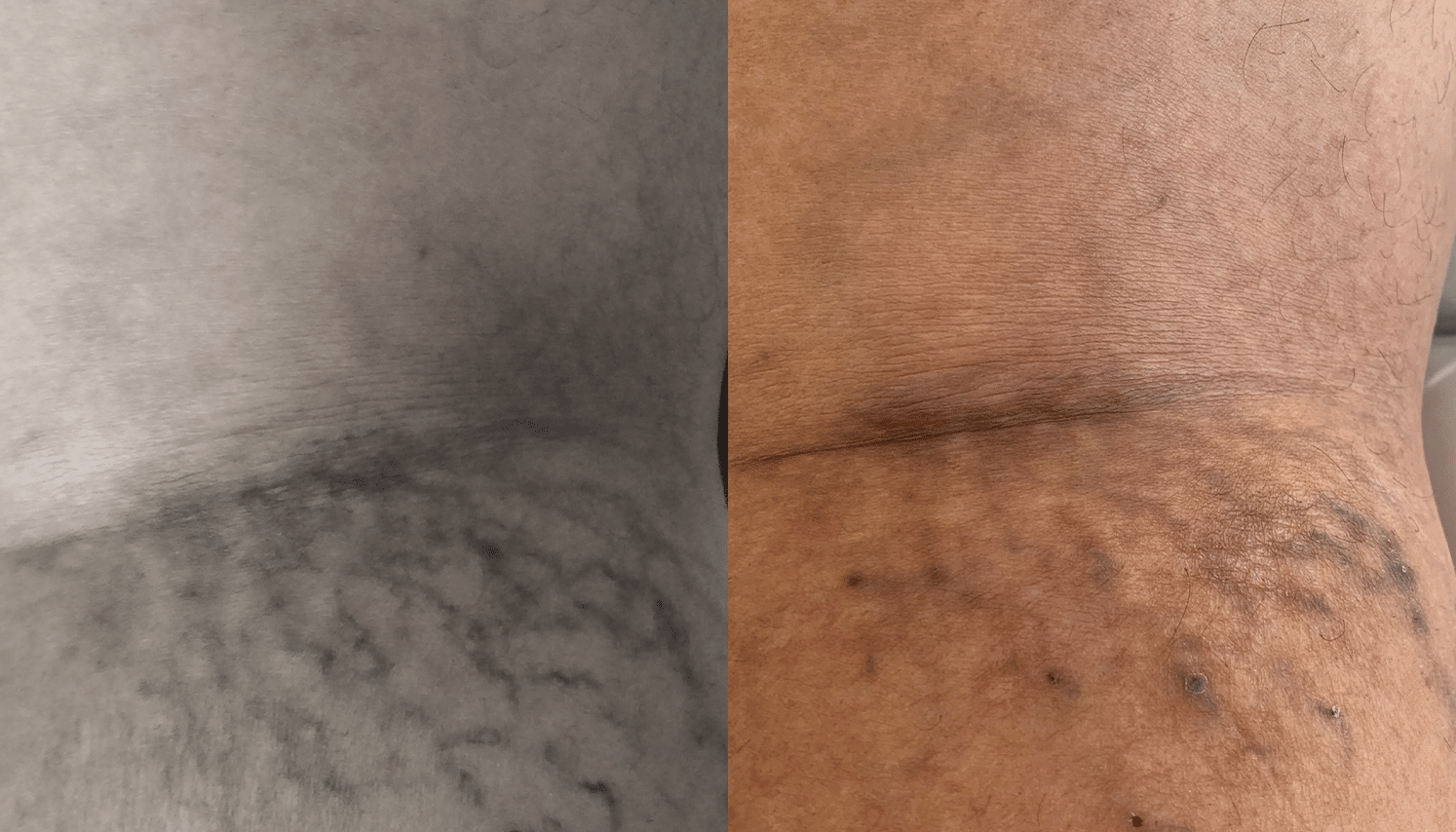 PEIM | Tratamento de Microvasos - Salvador 10 Ozonioterapia-4