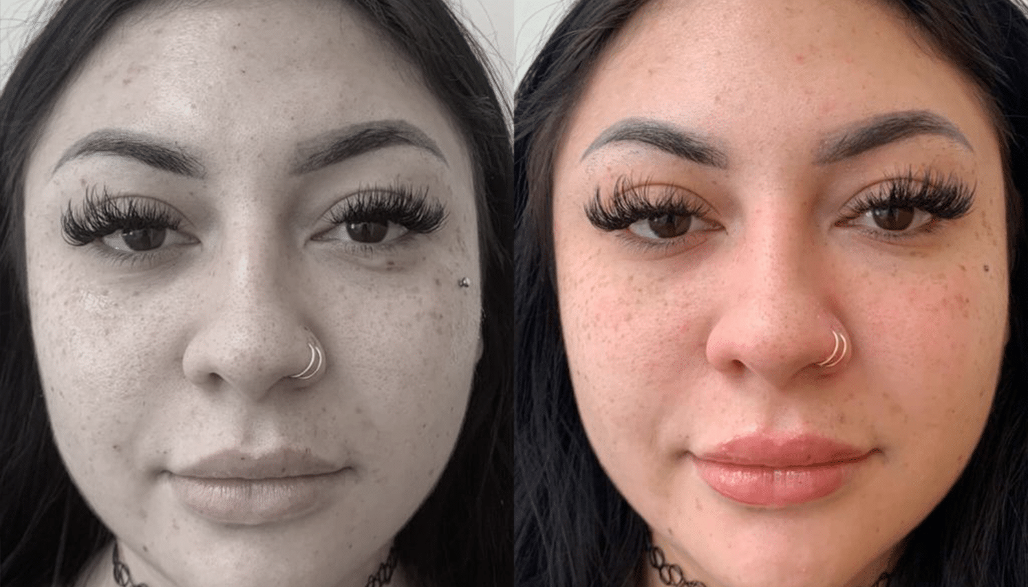 Eletrocautério | Remoção de Lesões Cutâneas - São Paulo 7 PRP-1