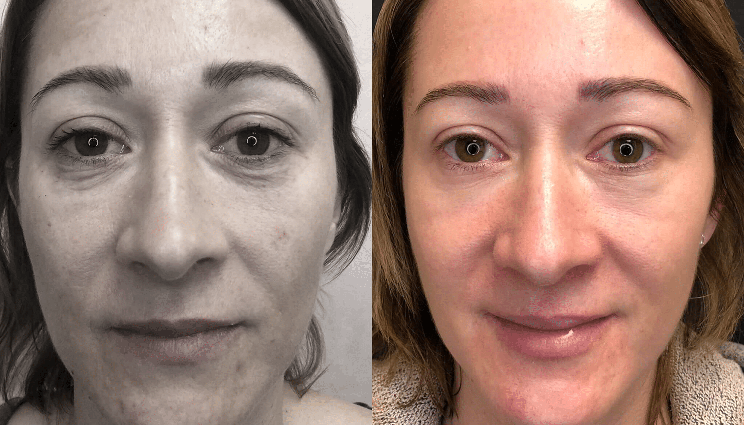 Eletrocautério | Remoção de Lesões Cutâneas - São Paulo 16 PRP-10