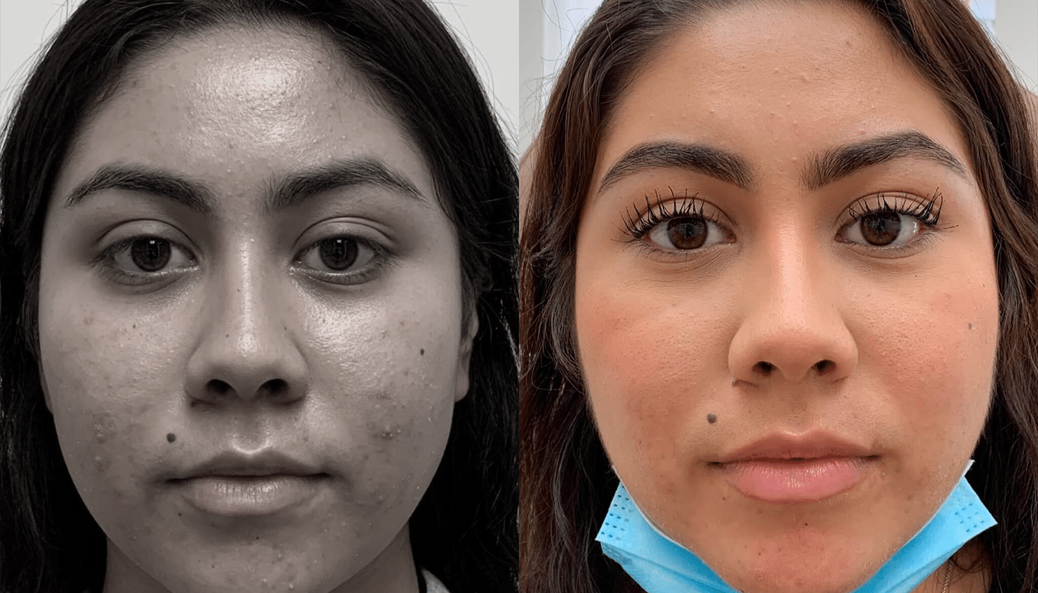 PRP & PRF | Plasma Rico em Plaquetas ou Fibrina - Goiânia 17 PRP-11