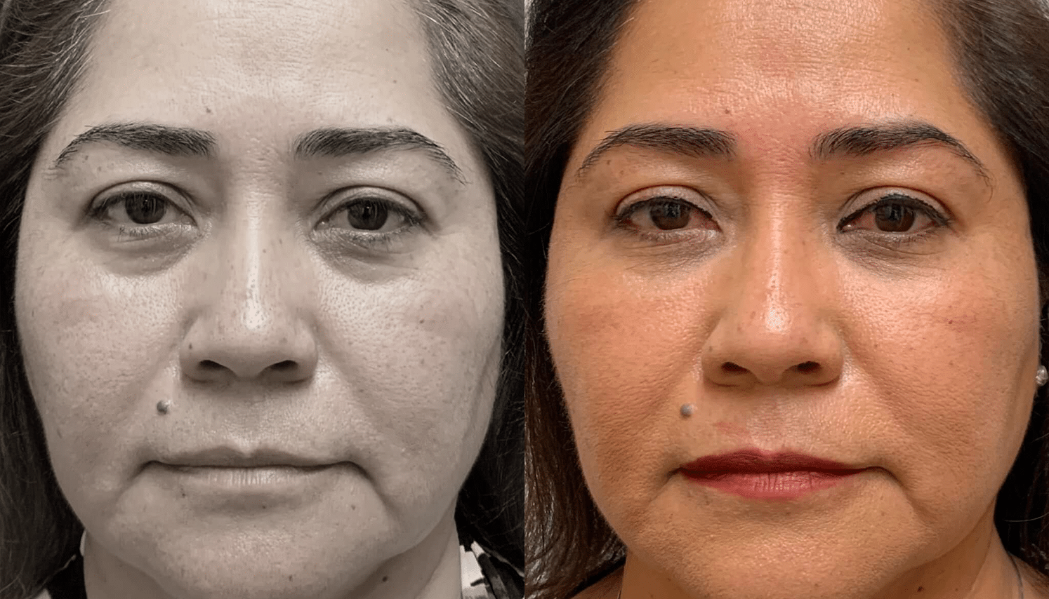 Eletrocautério | Remoção de Lesões Cutâneas - São Paulo 8 PRP-2