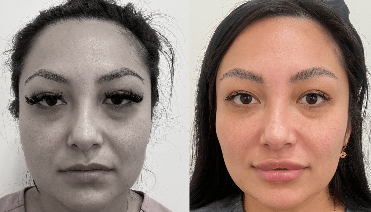 Eletrocautério | Remoção de Lesões Cutâneas - São Paulo 9 PRP-3