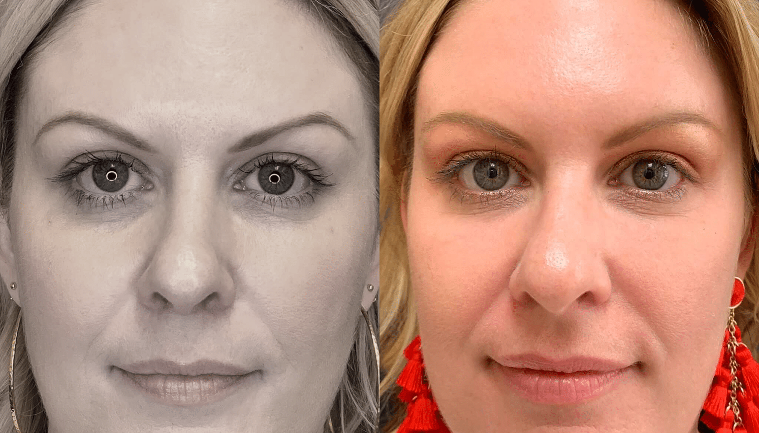 Eletrocautério | Remoção de Lesões Cutâneas - São Paulo 10 PRP-4