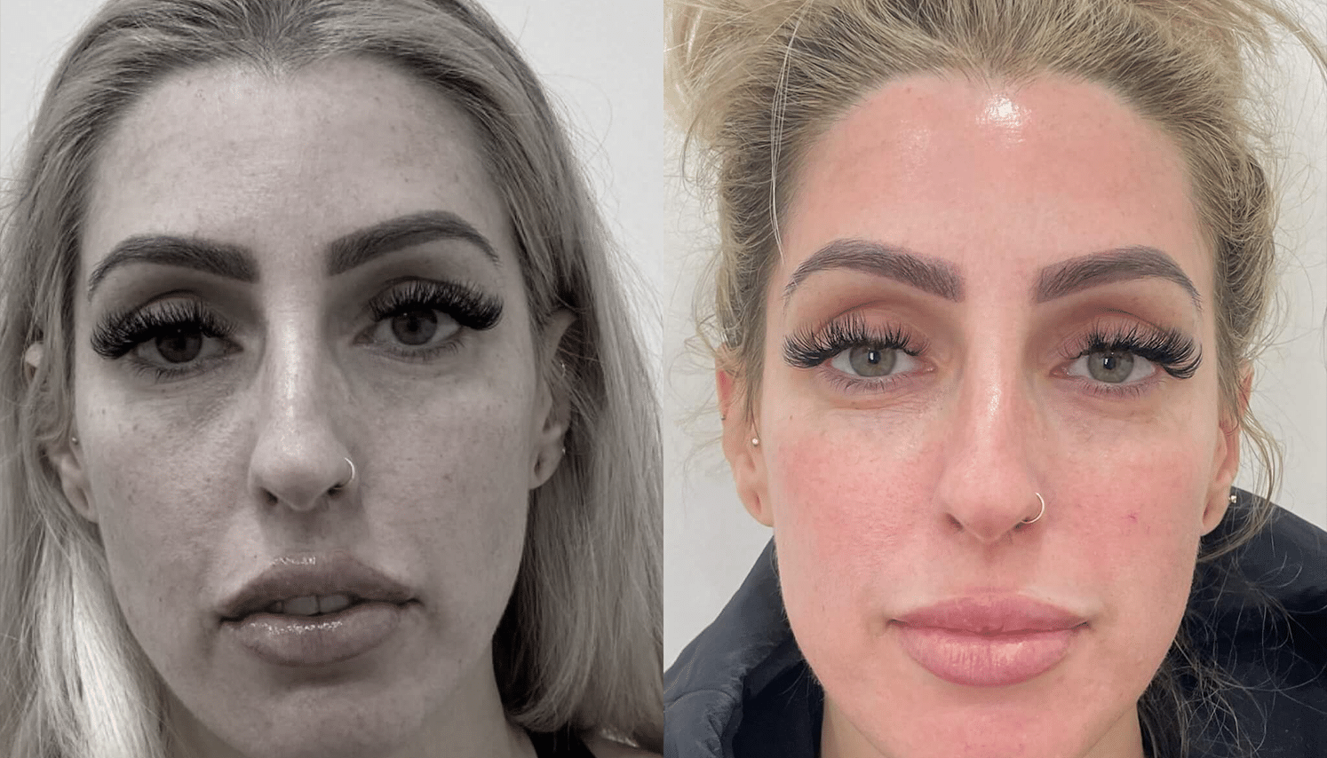 Eletrocautério | Remoção de Lesões Cutâneas - São Paulo 11 PRP-5