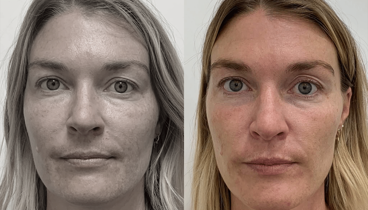 PRP & PRF | Plasma Rico em Plaquetas ou Fibrina - Goiânia 12 PRP-6