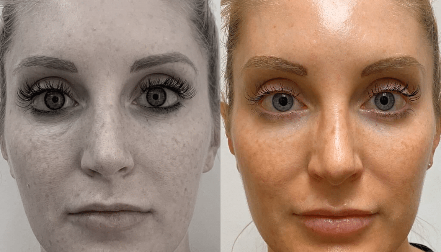 Eletrocautério | Remoção de Lesões Cutâneas - São Paulo 13 PRP-7