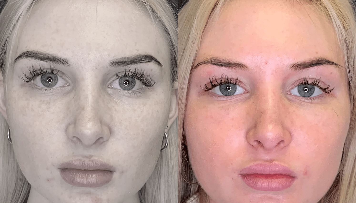 Eletrocautério | Remoção de Lesões Cutâneas - São Paulo 14 PRP-8