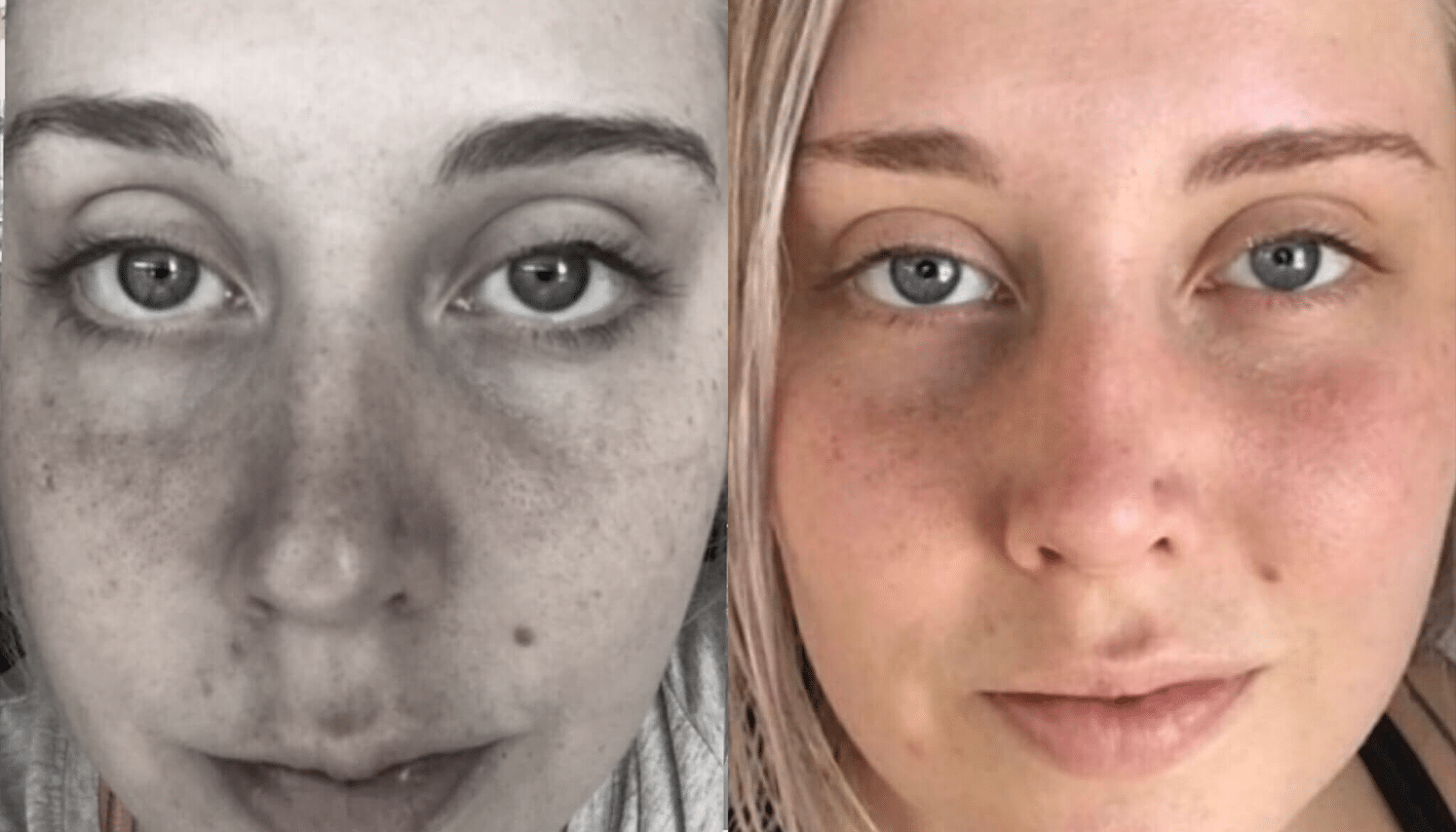 PRP & PRF | Plasma Rico em Plaquetas ou Fibrina - Goiânia 15 PRP-9