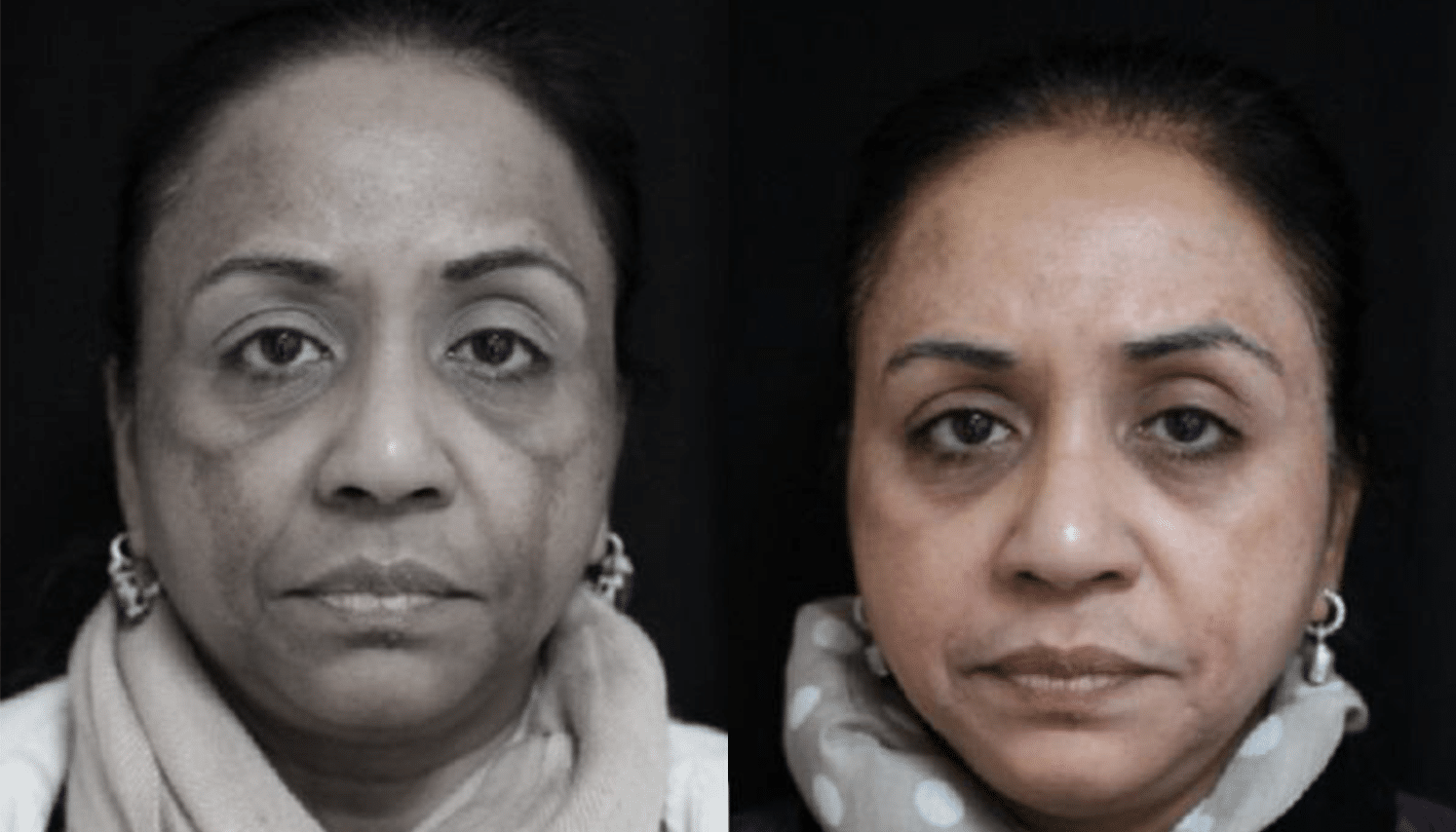 Peelings Químicos & Físicos - Rio de Janeiro 6 PeelingQM-1