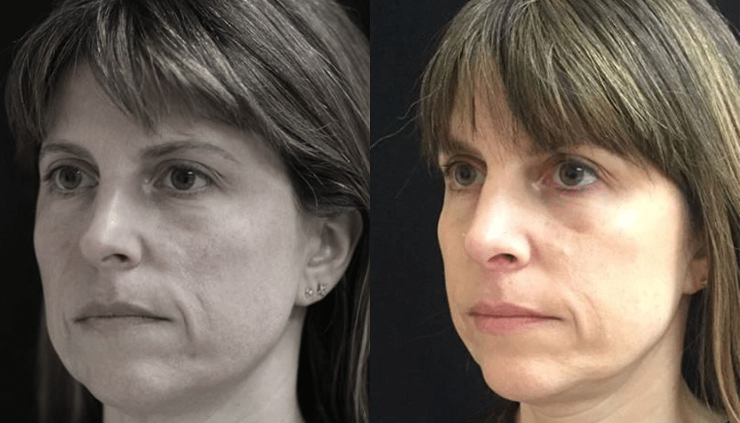 Peelings Químicos & Físicos - Rio de Janeiro 7 PeelingQM-2