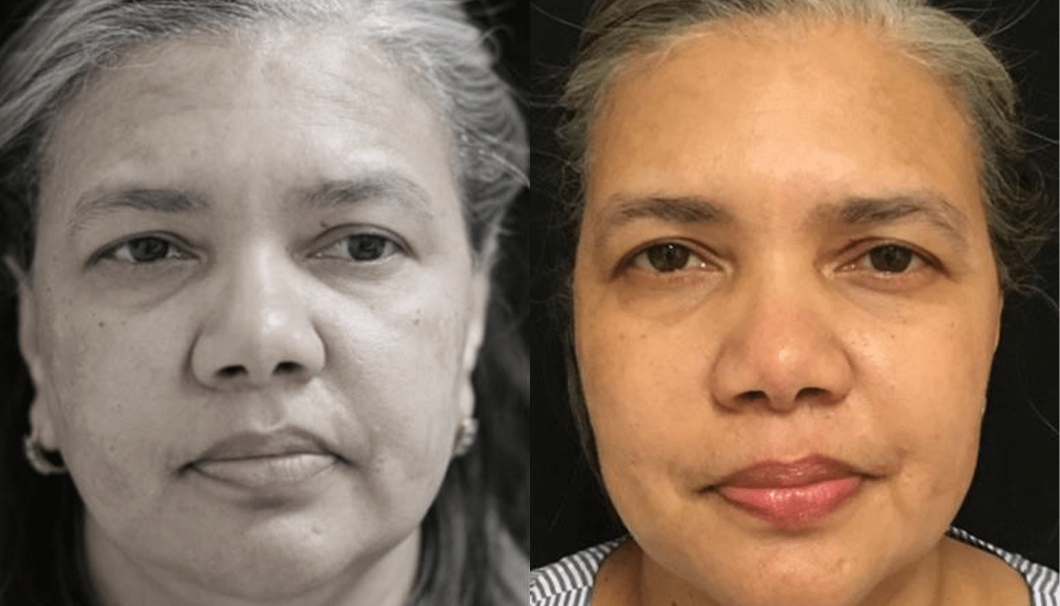 Peelings Químicos & Físicos - Rio de Janeiro 8 PeelingQM-3