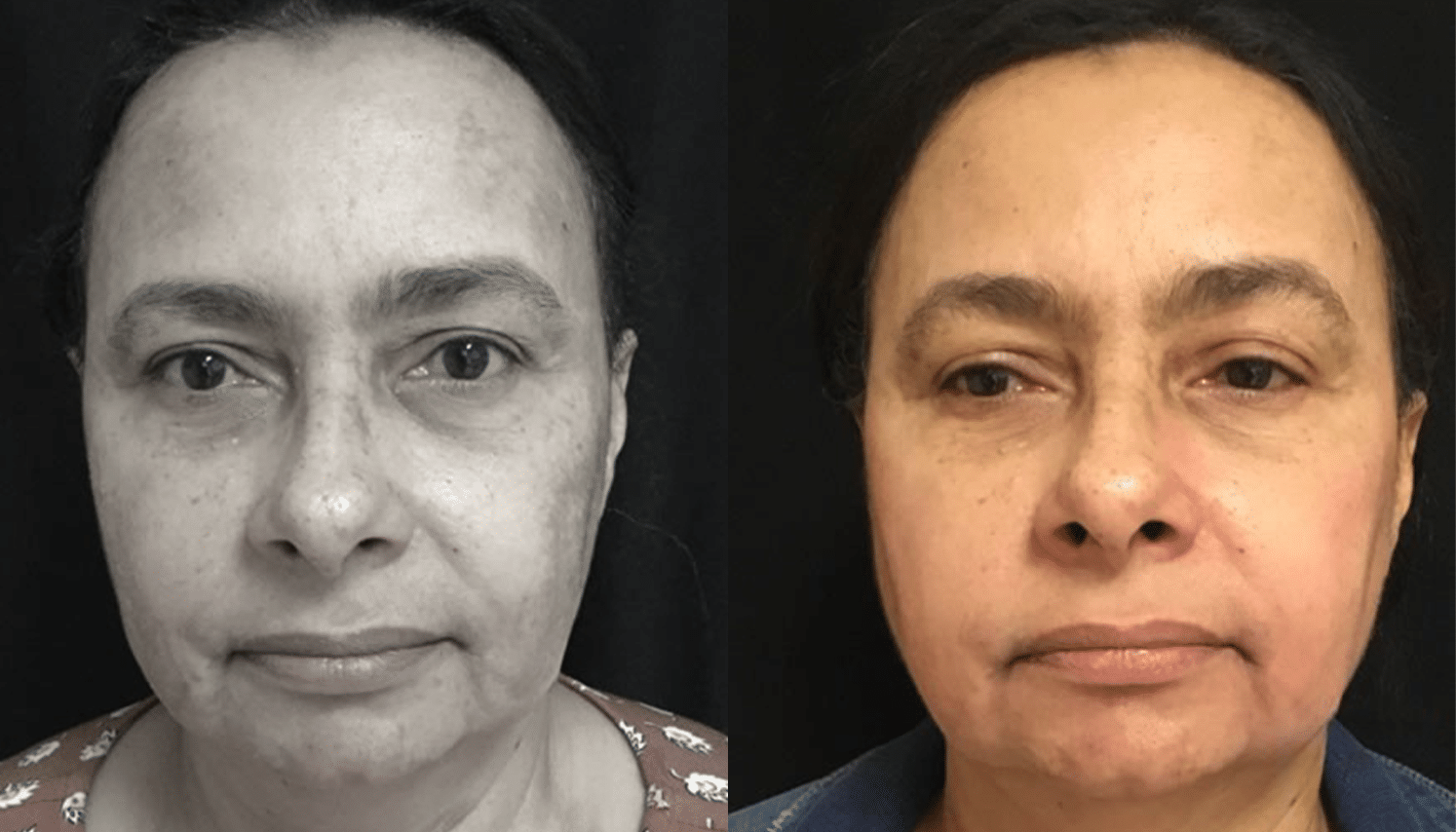 Peelings Químicos & Físicos - Rio de Janeiro 9 PeelingQM-4