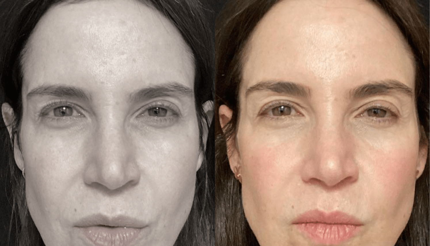 Peelings Químicos & Físicos - Rio de Janeiro 10 PeelingQM-5