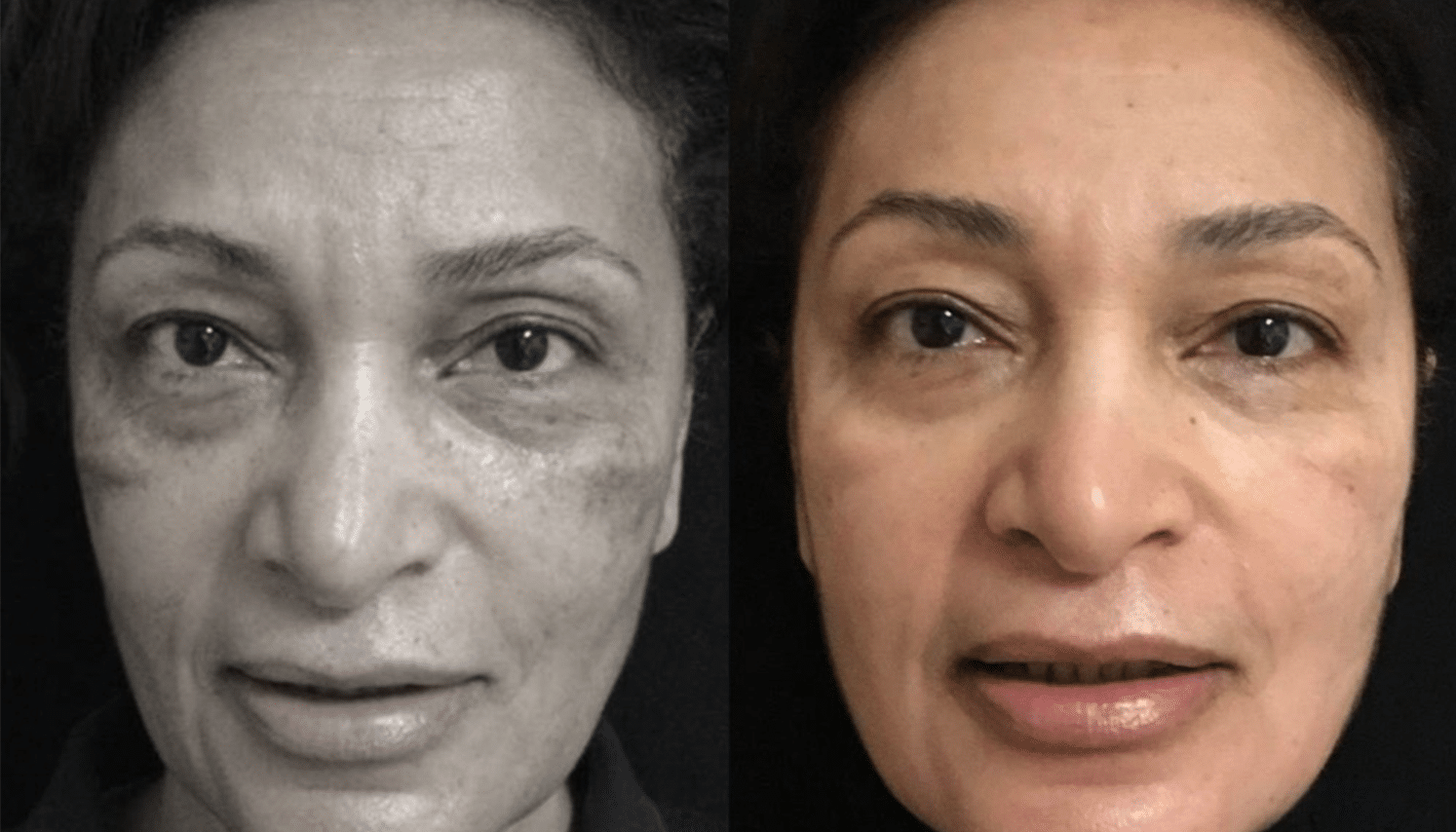 Peelings Químicos & Físicos - Rio de Janeiro 11 PeelingQM-6