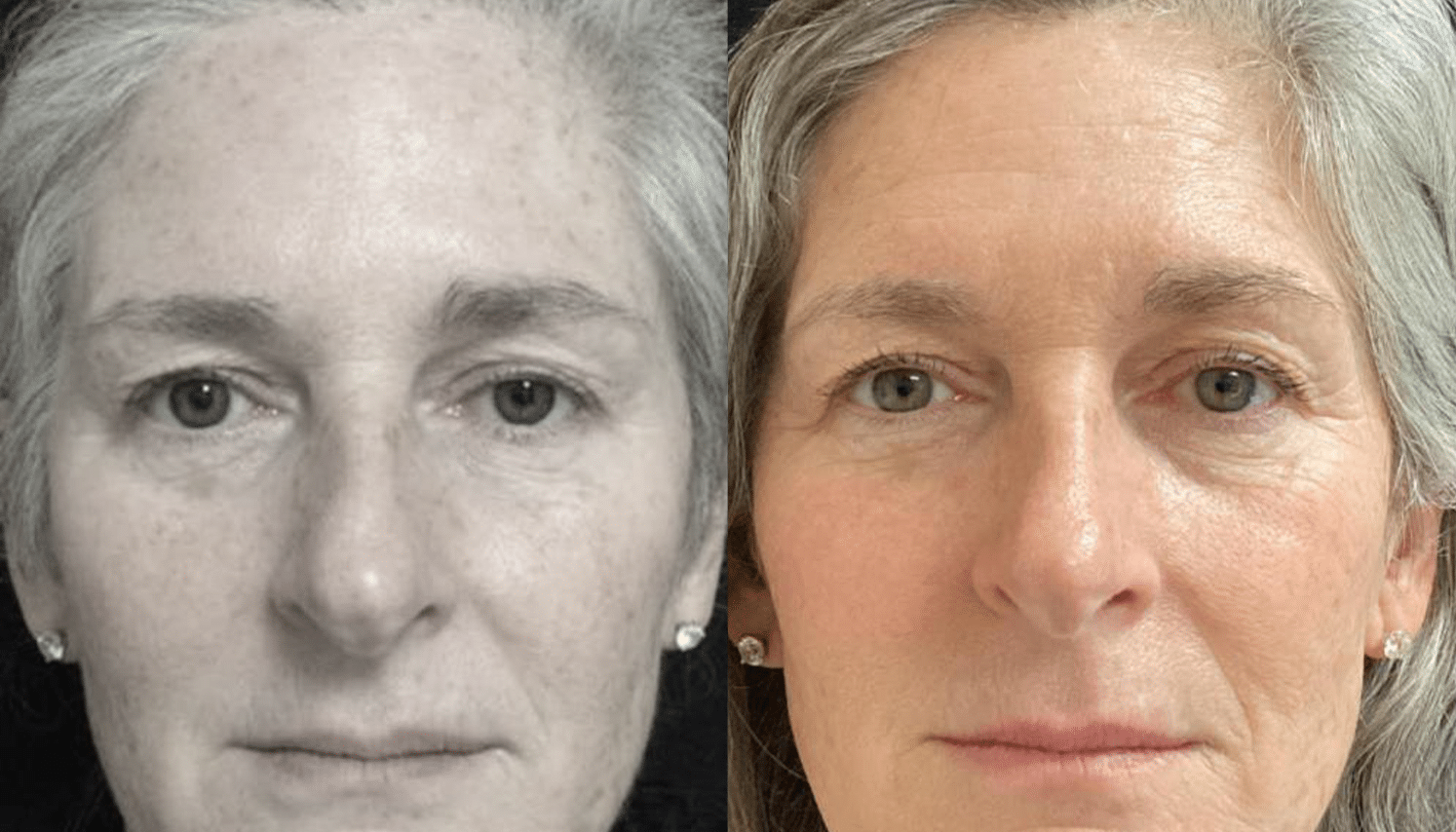 Peelings Químicos & Físicos - Rio de Janeiro 12 PeelingQM-7