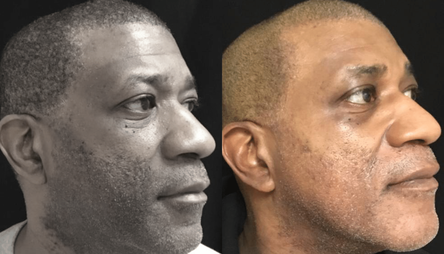 Peelings Químicos & Físicos - Rio de Janeiro 13 PeelingQM-8