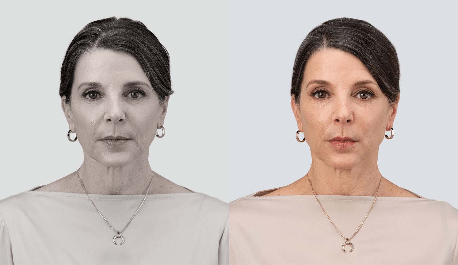 PreechimentoF-Antes e Depois-1