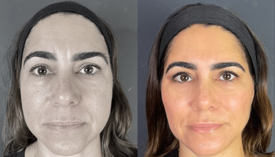 PreechimentoF-Antes e Depois-2