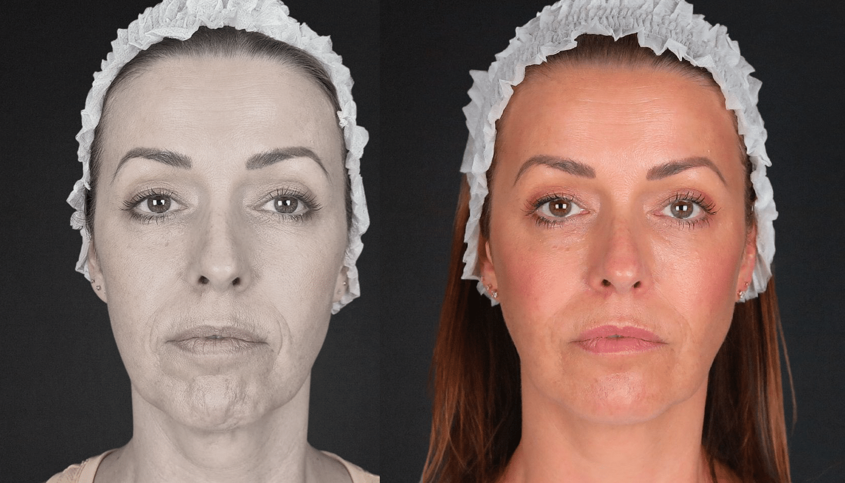 PreechimentoF-Antes e Depois-3
