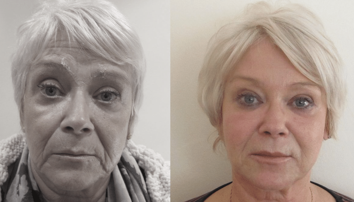 PreechimentoF-Antes e Depois-4