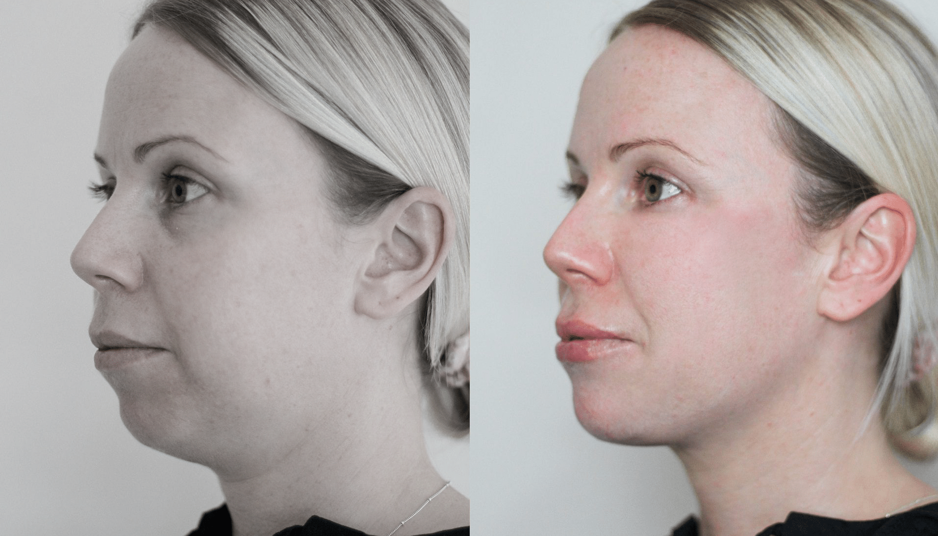 PreechimentoF-Antes e Depois-5