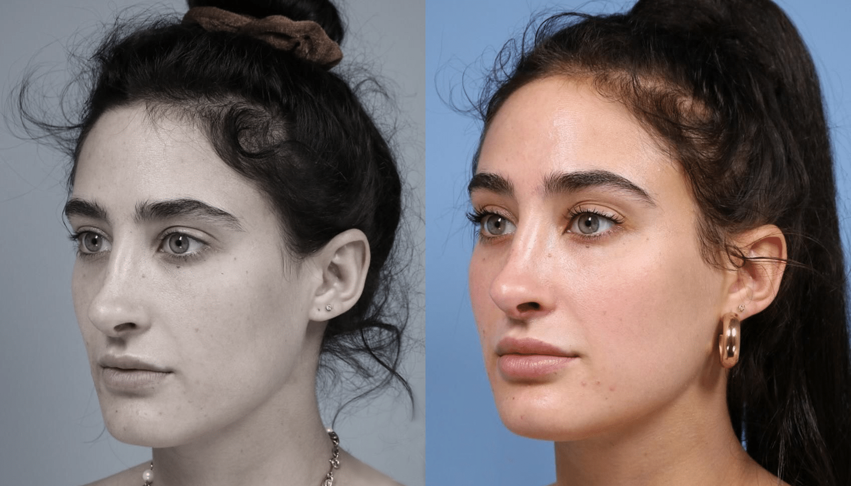 PreechimentoF-Antes e Depois-6