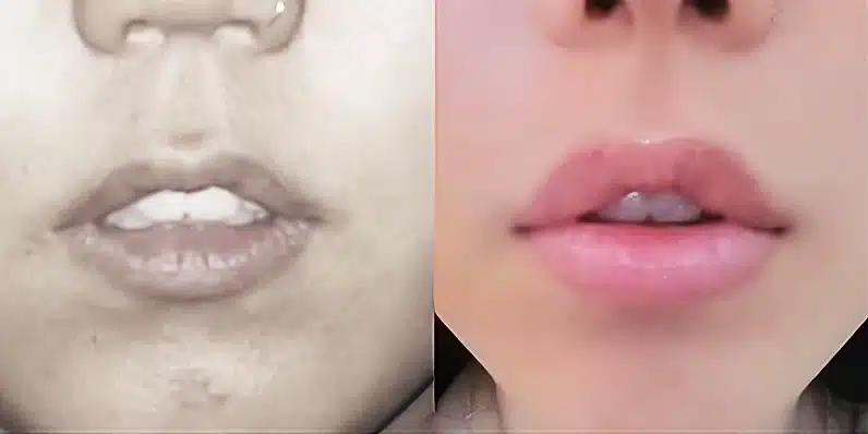 Preenchimento-Labial-1