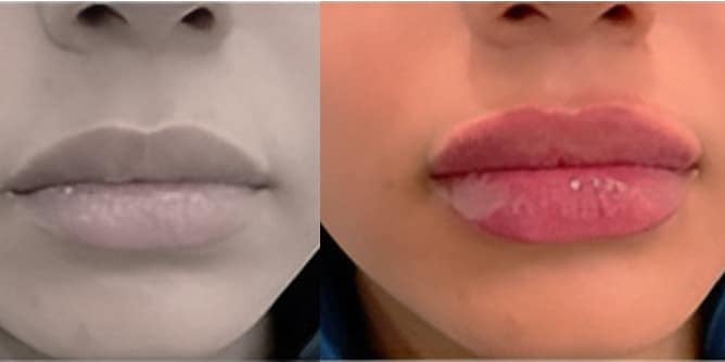 Preenchimento-Labial-10
