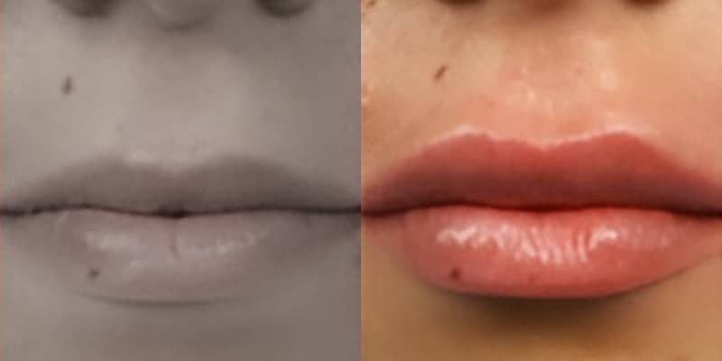 Preenchimento-Labial-11