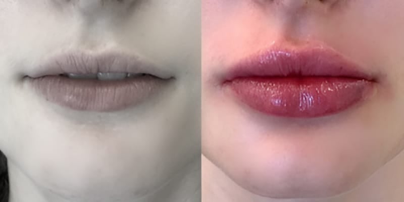 Preenchimento-Labial-2
