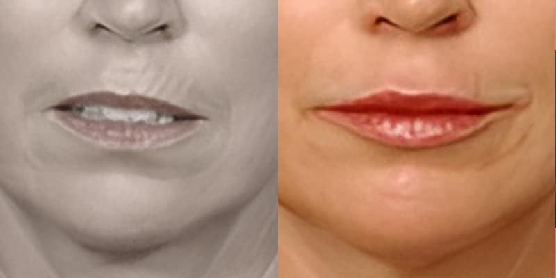 Preenchimento-Labial-3