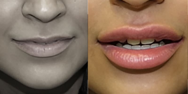 Preenchimento-Labial-4