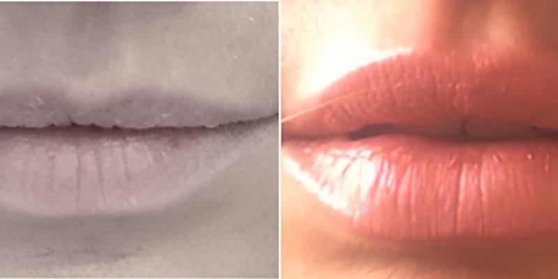 Preenchimento-Labial-5