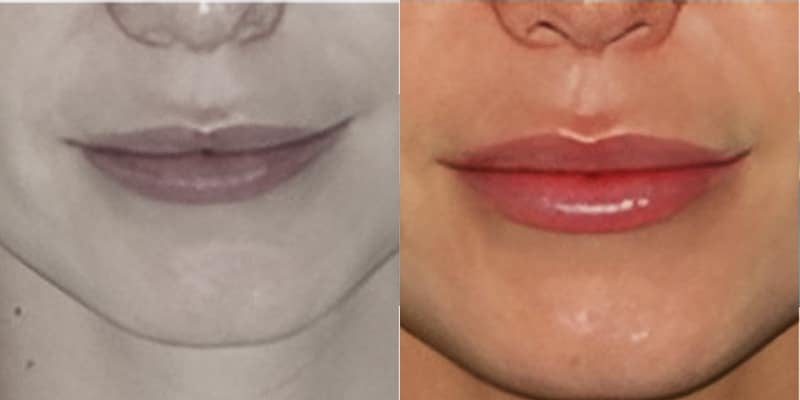 Preenchimento-Labial-7