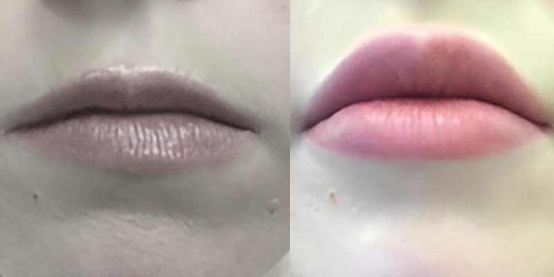Preenchimento-Labial-8