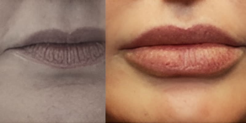 Preenchimento-Labial-9
