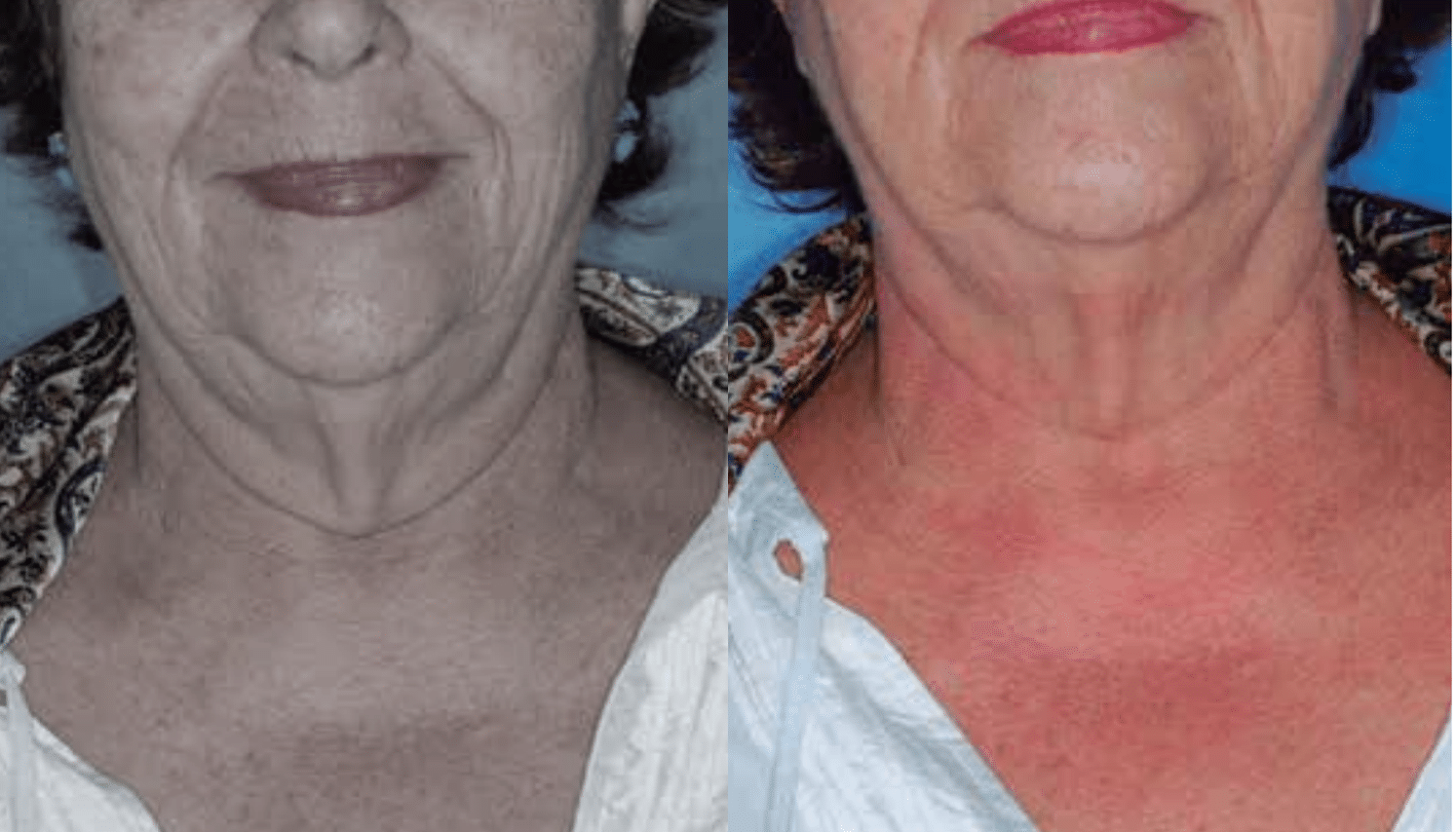 Radiofrequência Corporal e Facial - São Paulo 8 Radiofrequencia-2