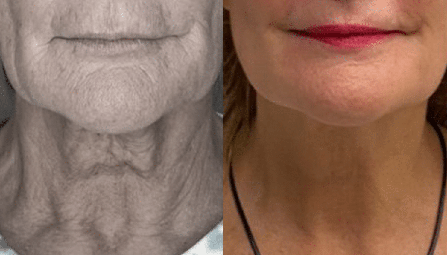 Radiofrequência Corporal e Facial - São Paulo 9 Radiofrequencia-3