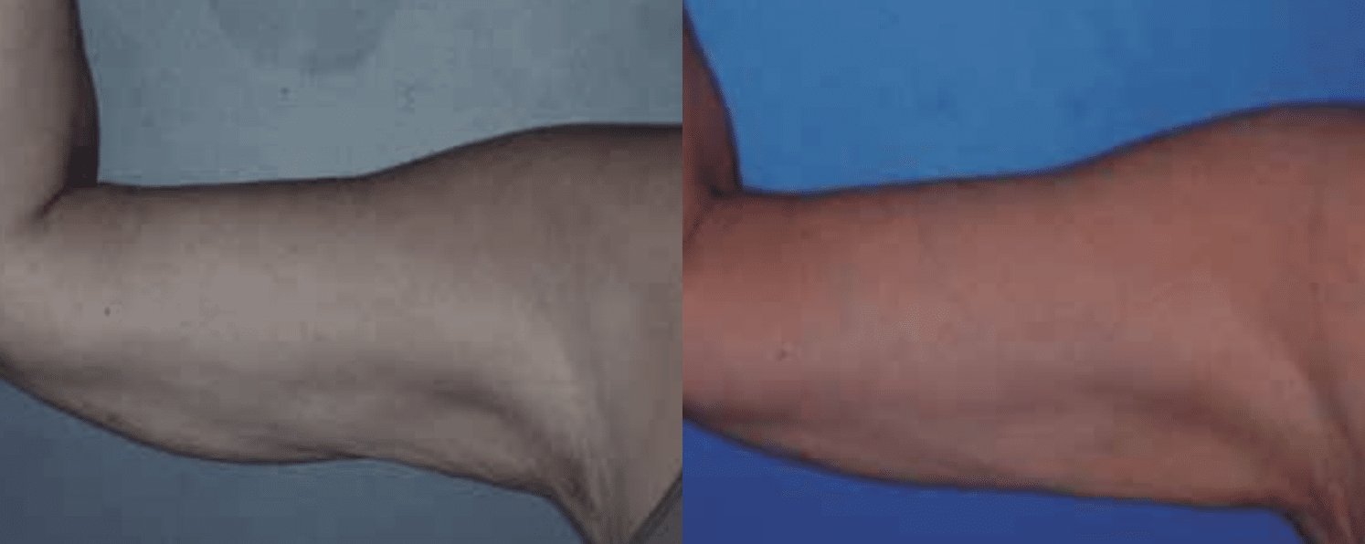 Radiofrequência Corporal e Facial - São Paulo 11 Radiofrequencia-5