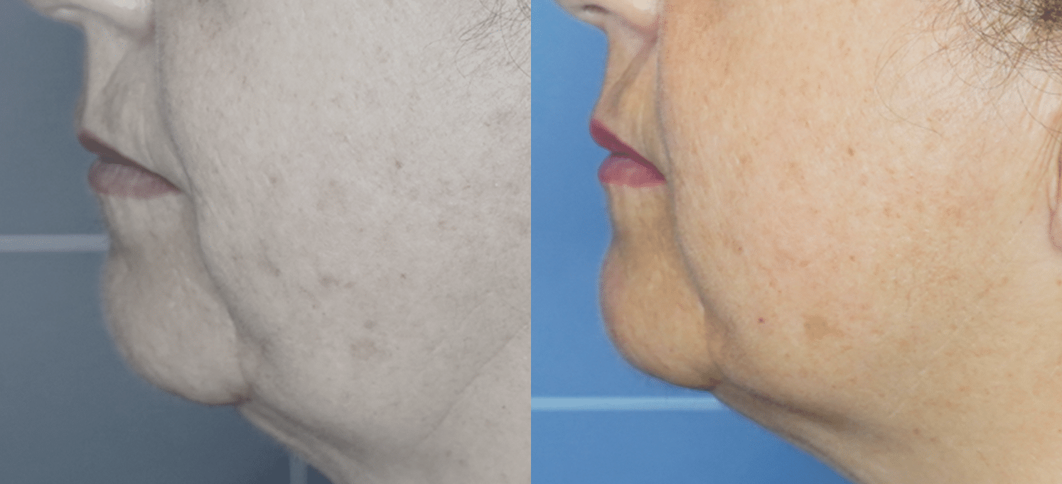 Radiofrequência Corporal e Facial - São Paulo 14 Radiofrequencia-8